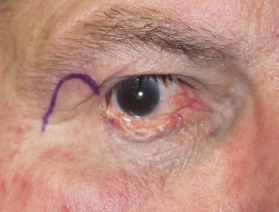 Az alsó szemhéj középső részét teljesen elfoglaló rosszindulatú tumor.