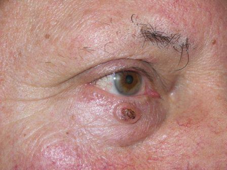 Lassan növekvő rosszindulatú tumor az alsó szemhéjon.