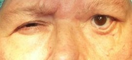 Bal oldali arcidegbénulás utáni szemhéjkifordulás és megereszkedés.