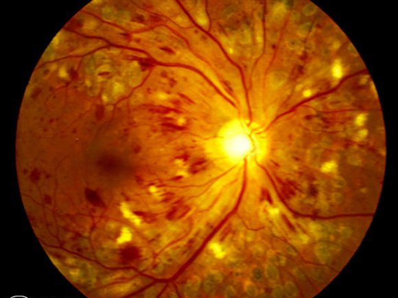 Diabéteszes retinopátia elleni injekció