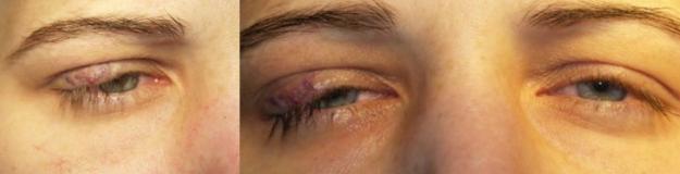 Fiatal hölgy felső szemhéján lassan növekvő tumor (haemangioma). A tumora szemhéj teljes vastagságában megtalálható.