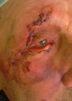 Kerti sérülés utáni alsó és felső, valamint arcsérülés utáni első ellátás képe (más intézményben történt). A seb az arcról a szemüldökívig húzódik a szemhéjak érintésével. Sérült a külső zug, teljesen leszakadt az alsó szemhéj és kettészakadt a felső szemhéj.