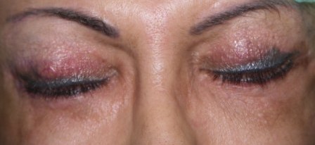 A megemelt alsó szemhéj miatt a páciens be tudja csukni a szemét, így megszűnt az irritáció és könnyezés. A lágy kontaktlencsét ismét egész nap tudja viselni.