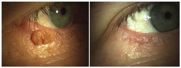 Közönséges szemölcs az alsó szemhéjon (verruca vulgaris) műtét előtt és 10 nappal műtét után