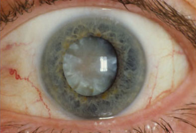 látás műtét után szürkehályog-glaukóma