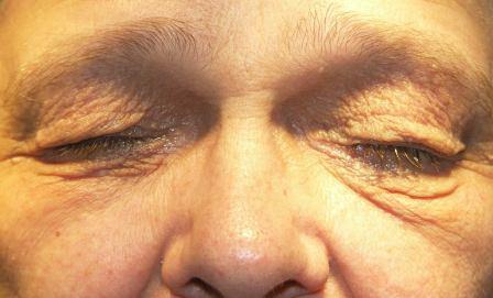 Behunyt szemmel jól láthatóan a bőrfelesleg több redőt vetve nehezedik a felső szemhéj pillasorára. A szempillák egy része rendellenes helyzetet felvéve további irritáló tényezőként lépnek fel.