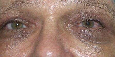 A szemhéjak visszanyerték rendes küllemüket, további irritációt nem okoznak. A szempillák helyzete is megfelelő.