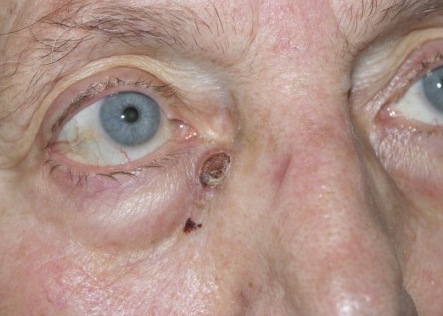 Rosszindulatú tumor az orrgyök területén.